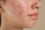 young woman's face with acne