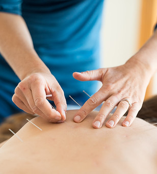 woman receiving acupuncture