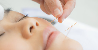 facial rejuvenation acupuncture 