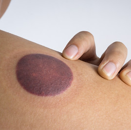 cupping mark 